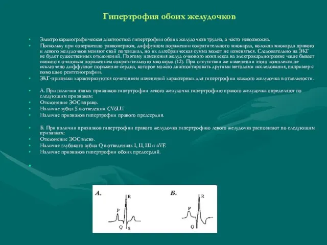 Гипертрофия обоих желудочков Электрокардиографическая диагностика гипертрофии обоих желудочков трудна, а часто невозможна.