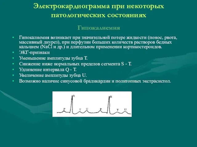 Электрокардиограмма при некоторых патологических состояниях Гипокалиемия Гипокалиемия возникает при значительной потере жидкости