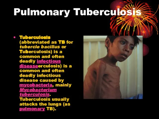 Pulmonary Tuberculosis Tuberculosis (abbreviated as TB for tubercle bacillus or Tuberculosis) is