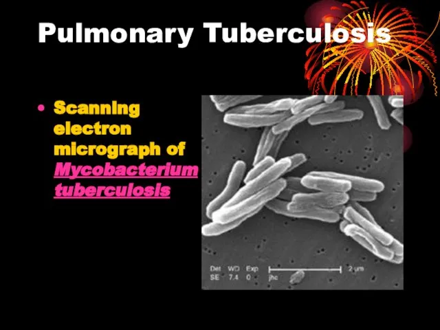 Pulmonary Tuberculosis Scanning electron micrograph of Mycobacterium tuberculosis