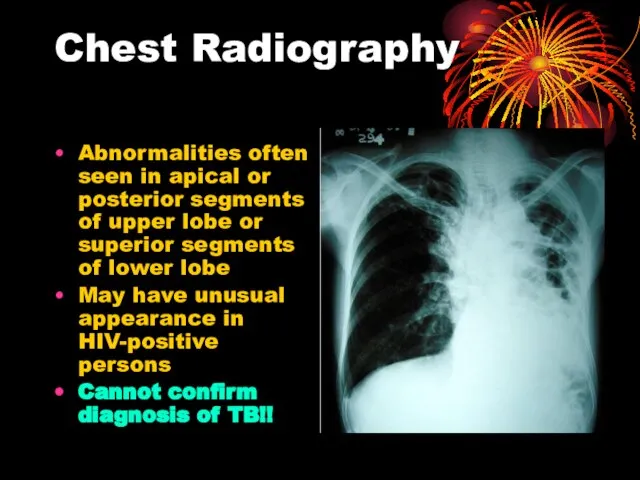 Chest Radiography Abnormalities often seen in apical or posterior segments of upper