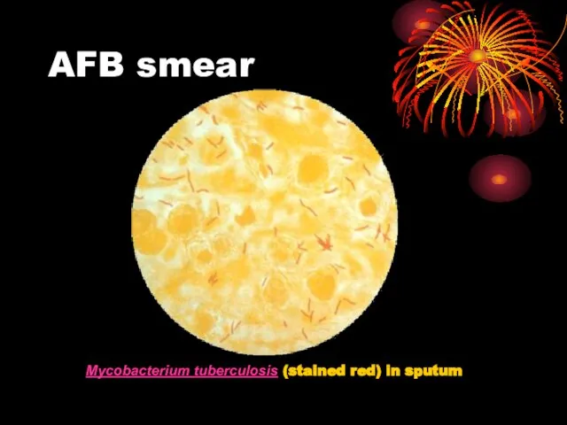 AFB smear Mycobacterium tuberculosis (stained red) in sputum