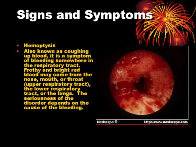 Signs and Symptoms Hemoptysis Also known as coughing up blood, it is