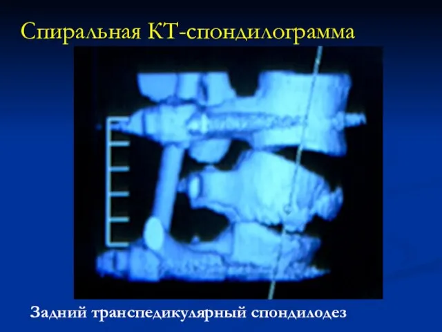 Спиральная КТ-спондилограмма Задний транспедикулярный спондилодез