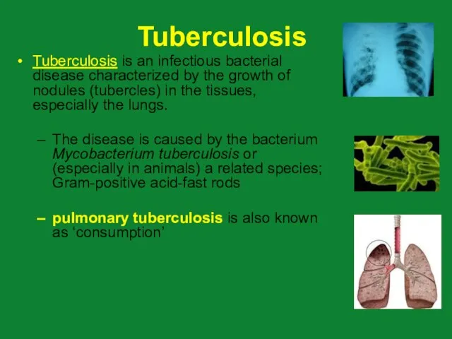 Tuberculosis Tuberculosis is an infectious bacterial disease characterized by the growth of