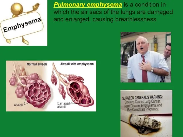 Pulmonary emphysema is a condition in which the air sacs of the