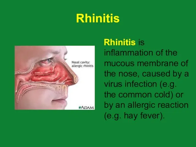 Rhinitis Rhinitis is inflammation of the mucous membrane of the nose, caused