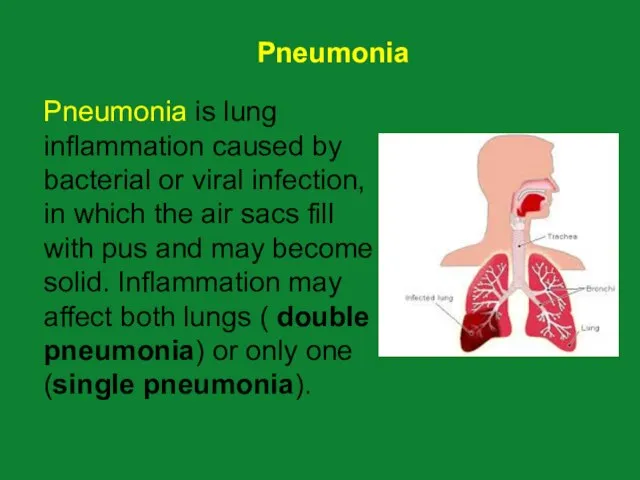 Pneumonia is lung inflammation caused by bacterial or viral infection, in which