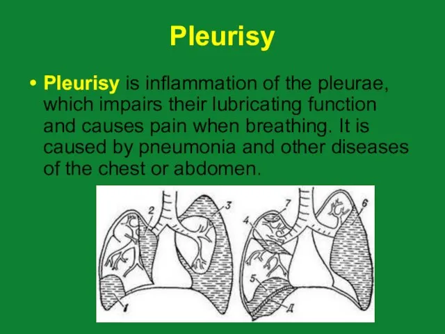 Pleurisy Pleurisy is inflammation of the pleurae, which impairs their lubricating function