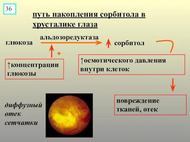 + глюкоза сорбитол альдозоредуктаза путь накопления сорбитола в хрусталике глаза ↑концентрации глюкозы