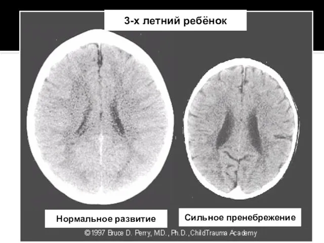 3-х летний ребёнок Нормальное развитие Сильное пренебрежение