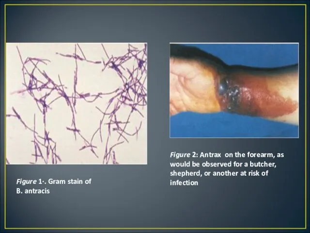 Figure 1·. Gram stain of B. antracis Figure 2: Antrax on the