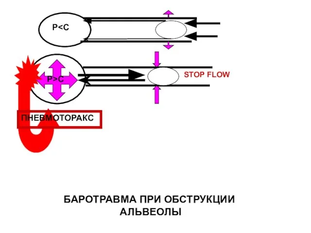 P>C P STOP FLOW БАРОТРАВМА ПРИ ОБСТРУКЦИИ АЛЬВЕОЛЫ ПНЕВМОТОРАКС