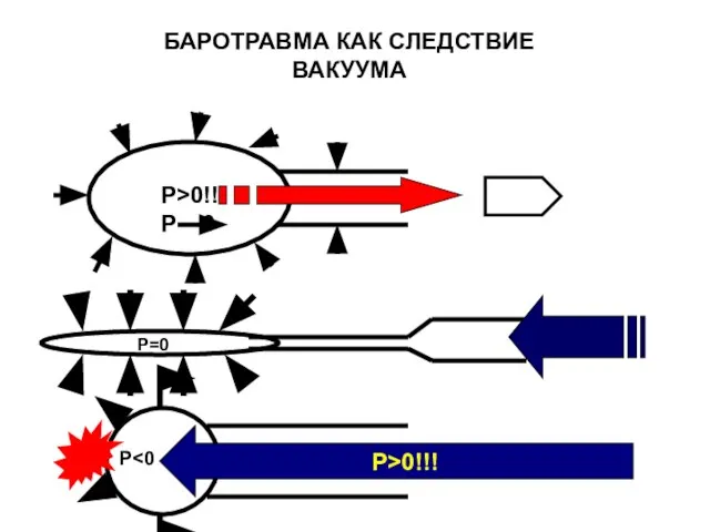 P>0!! P 0 P>0!!! P=0 P БАРОТРАВМА КАК СЛЕДСТВИЕ ВАКУУМА