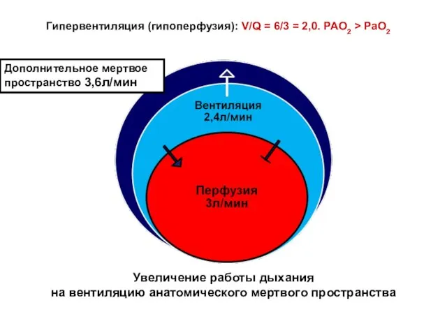 Гипервентиляция (гипоперфузия): V/Q = 6/3 = 2,0. PAO2 > PaO2 Дополнительное мертвое