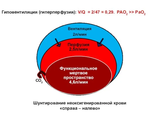 Гиповентиляция (гиперперфузия): V/Q = 2/47 = 0,29. PAO2 >> PaO2 СО2 Шунтирование