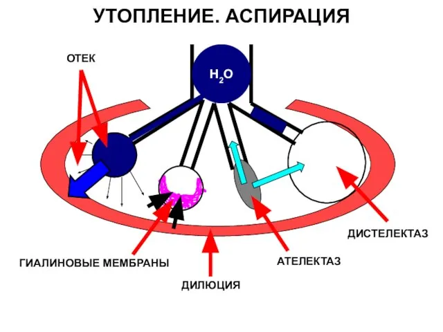 УТОПЛЕНИЕ. АСПИРАЦИЯ Н2О ОТЕК ДИЛЮЦИЯ ГИАЛИНОВЫЕ МЕМБРАНЫ АТЕЛЕКТАЗ ДИСТЕЛЕКТАЗ