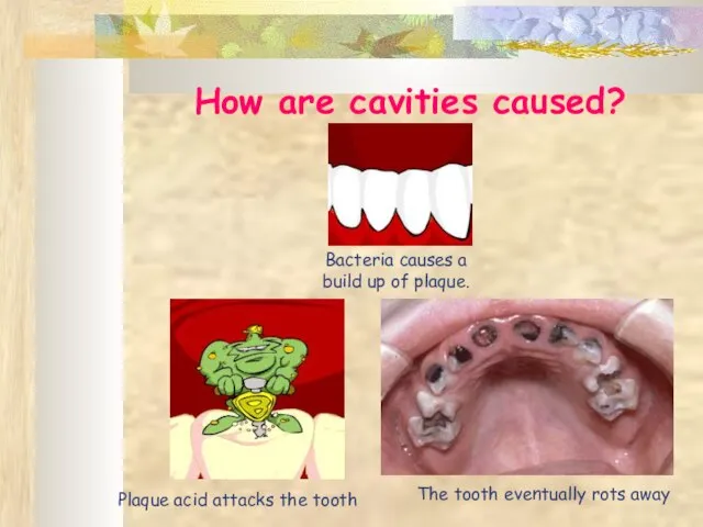 How are cavities caused? Bacteria causes a build up of plaque. Plaque