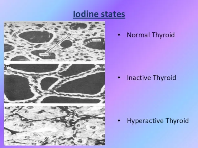 Iodine states Normal Thyroid Inactive Thyroid Hyperactive Thyroid