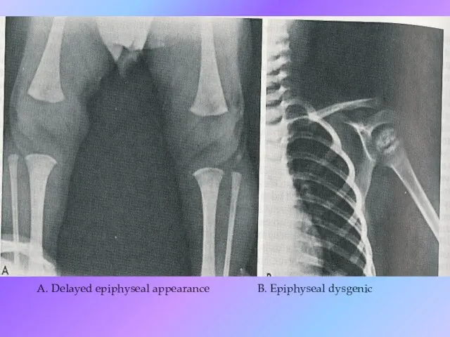 A. Delayed epiphyseal appearance B. Epiphyseal dysgenic