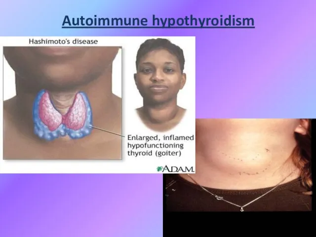 Autoimmune hypothyroidism