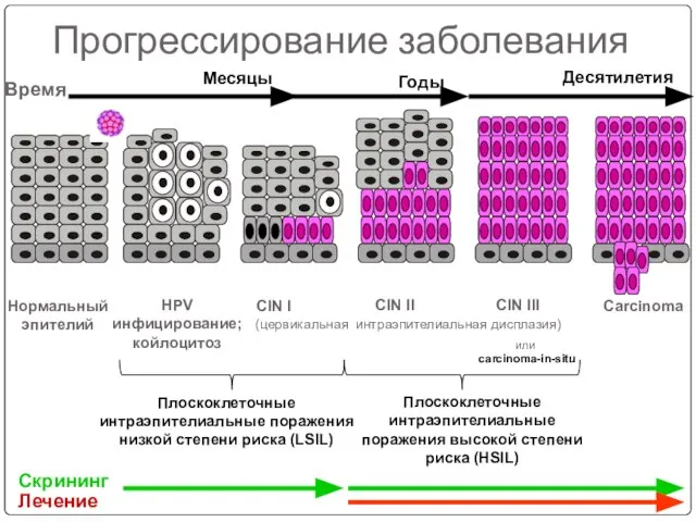 Прогрессирование заболевания Плоскоклеточные интраэпителиальные поражения низкой степени риска (LSIL) Плоскоклеточные интраэпителиальные поражения