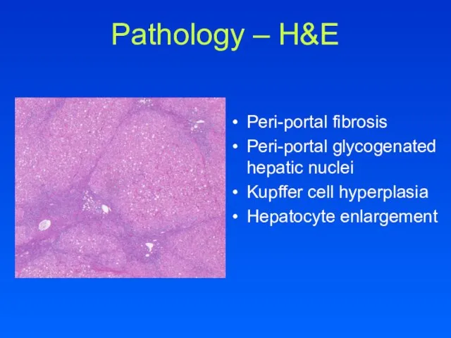 Pathology – H&E Peri-portal fibrosis Peri-portal glycogenated hepatic nuclei Kupffer cell hyperplasia Hepatocyte enlargement