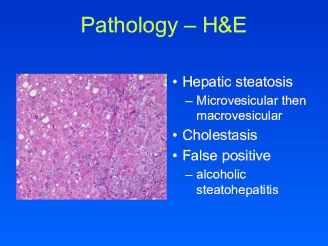 Pathology – H&E Hepatic steatosis Microvesicular then macrovesicular Cholestasis False positive alcoholic steatohepatitis