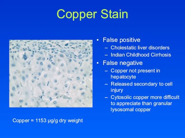 Copper Stain False positive Cholestatic liver disorders Indian Childhood Cirrhosis False negative