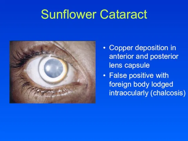 Sunflower Cataract Copper deposition in anterior and posterior lens capsule False positive