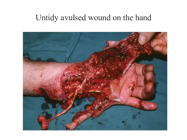 Untidy avulsed wound on the hand