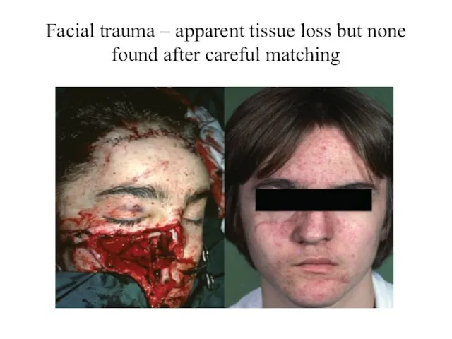 Facial trauma – apparent tissue loss but none found after careful matching