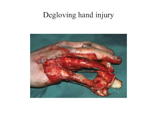 Degloving hand injury