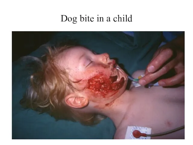 Dog bite in a child