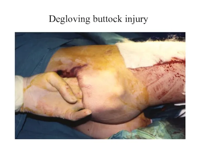 Degloving buttock injury