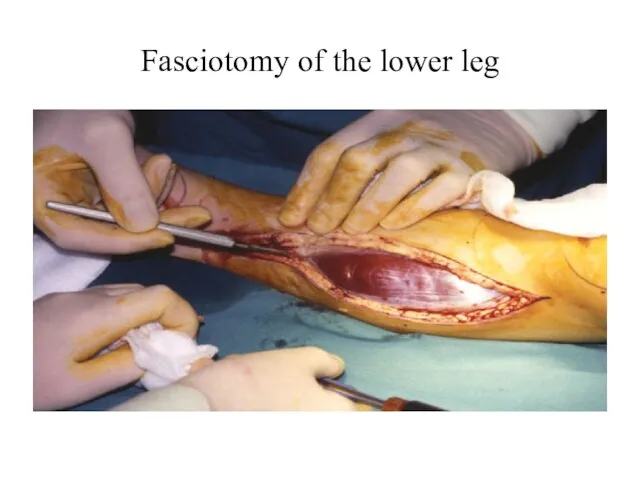 Fasciotomy of the lower leg