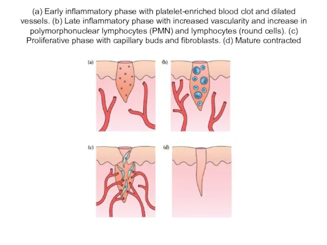 (a) Early inflammatory phase with platelet-enriched blood clot and dilated vessels. (b)