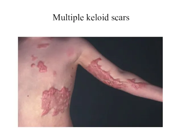 Multiple keloid scars