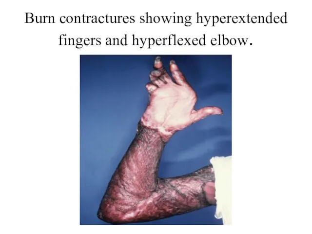 Burn contractures showing hyperextended fingers and hyperflexed elbow.