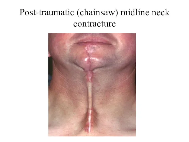 Post-traumatic (chainsaw) midline neck contracture