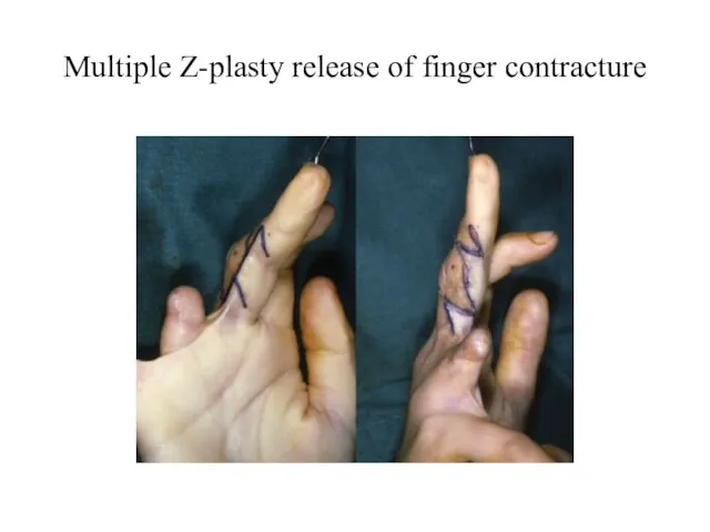 Multiple Z-plasty release of finger contracture