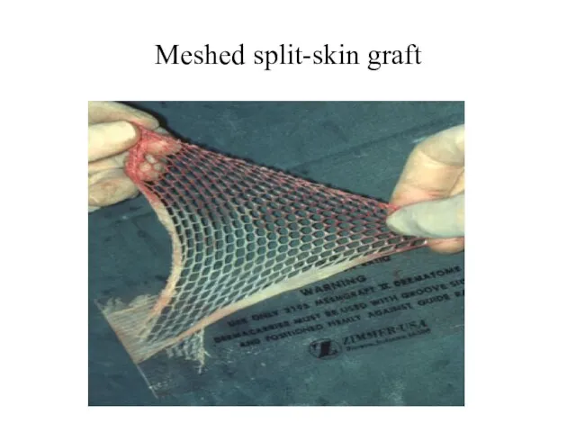 Meshed split-skin graft