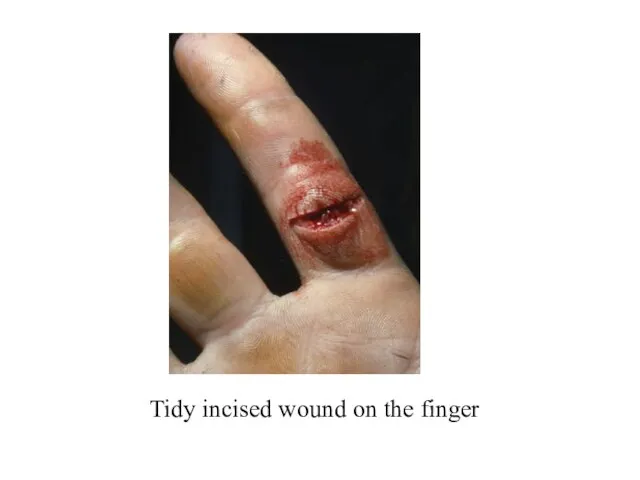 Tidy incised wound on the finger