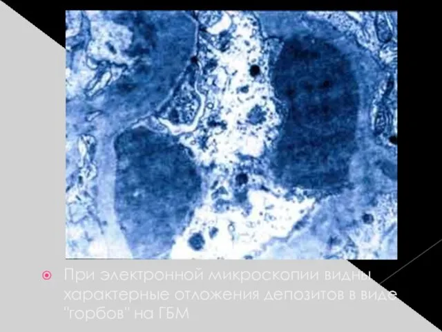При электронной микроскопии видны характерные отложения депозитов в виде "горбов" на ГБМ