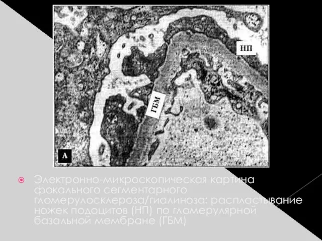 Электронно-микроскопическая картина фокального сегментарного гломерулосклероза/гиалиноза: распластывание ножек подоцитов (НП) по гломерулярной базальной мембране (ГБМ)