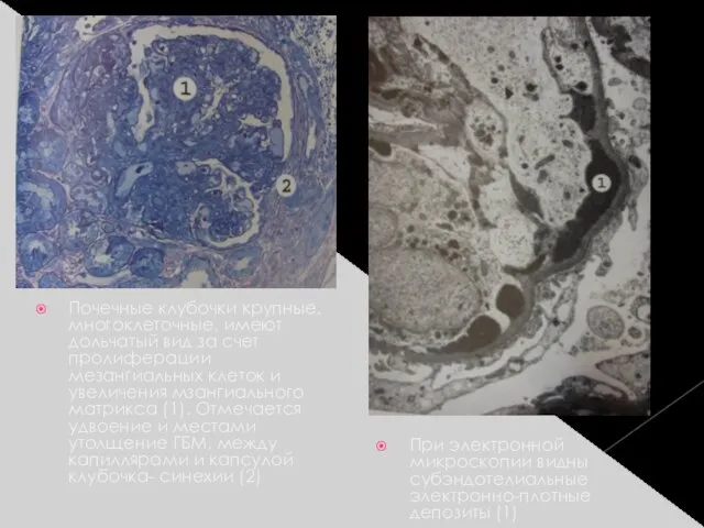 При электронной микроскопии видны субэндотелиальные электронно-плотные депозиты (1) Почечные клубочки крупные, многоклеточные,