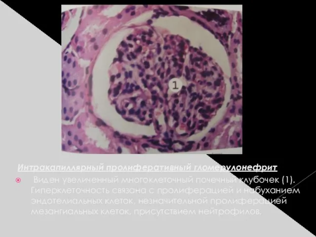 Интракапиллярный пролиферативный гломерулонефрит Виден увеличенный многоклеточный почечный клубочек (1). Гиперклеточность связана с