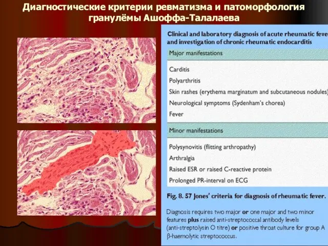 Диагностические критерии ревматизма и патоморфология гранулёмы Ашоффа-Талалаева