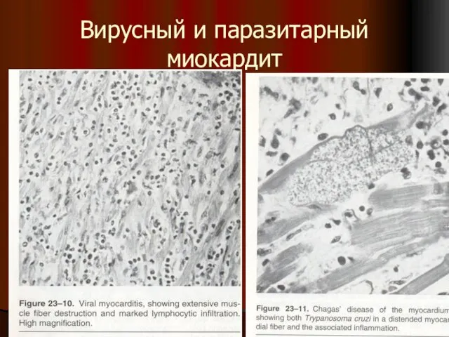 Вирусный и паразитарный миокардит