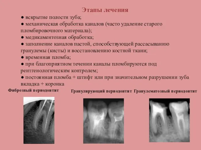 Этапы лечения ● вскрытие полости зуба; ● механическая обработка каналов (часто удаление